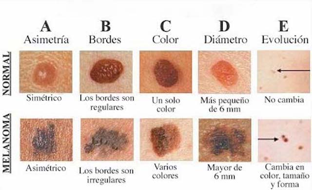 ¿Cómo detectar el cáncer de piel?