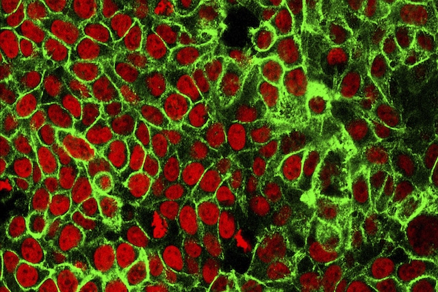 Cáncer colorrectal: recomiendan exámenes preventivos a partir de los 45 años